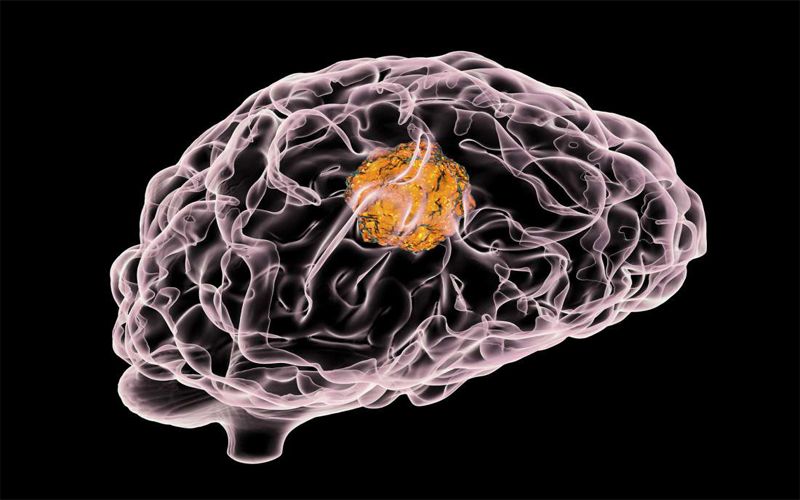 تومور مغزی چیست؟ | اطلاعات جامع درباره تومور مغزی
