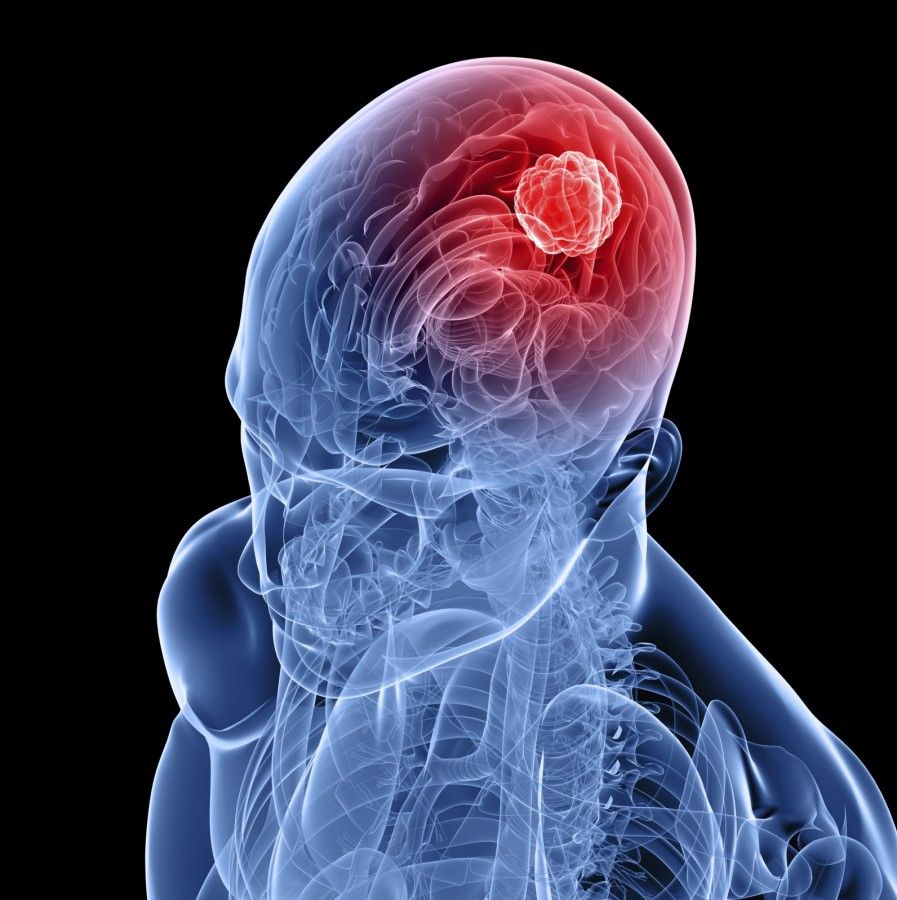 تومور مغزی چیست؟ | اطلاعات جامع درباره تومور مغزی