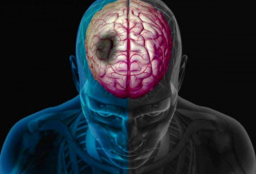 سکته مغزی: اطلاعات کامل برای نجات بیمار در سریع‌ترین زمان