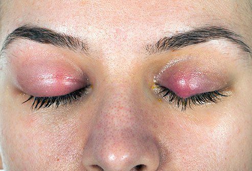 بلفاریت یا التهاب چشم | علایم، عوارض و درمان بلفاریت یا التهاب چشم