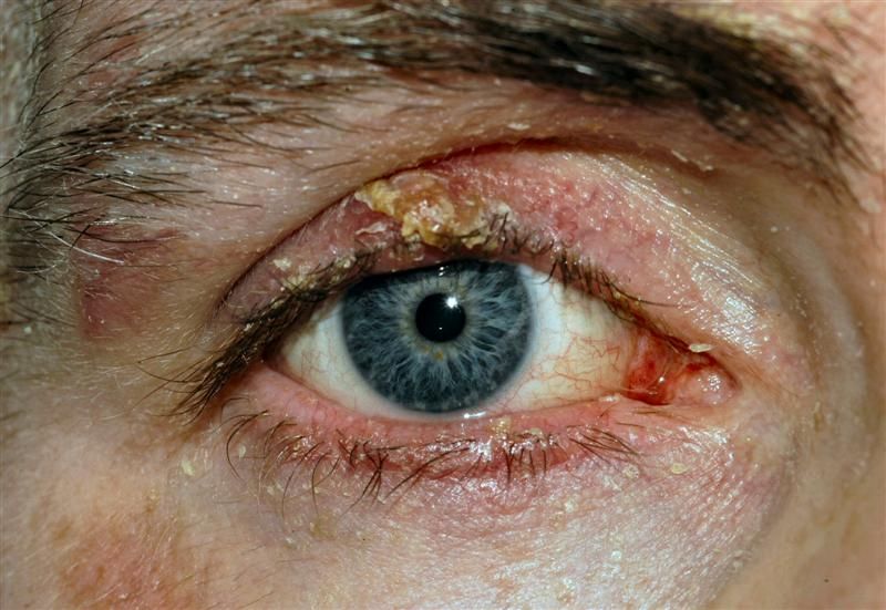 بلفاریت یا التهاب چشم | علایم، عوارض و درمان بلفاریت یا التهاب چشم