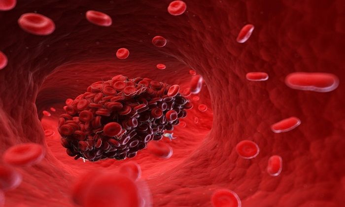 لخته شدن خون | علل و عوارض لخته شدن خون چیست؟