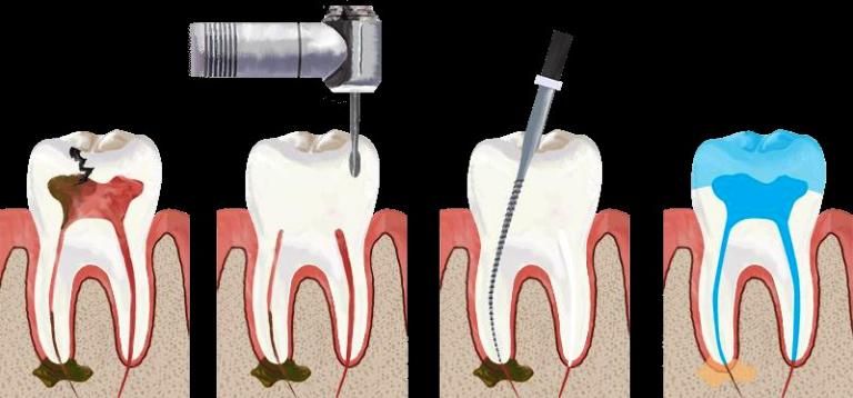 عصب کشی دندان | دندان را عصب کشی کنید تا نکشید