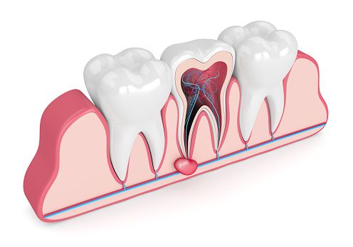 کیست دندان | کیست دندان چرا بوجود می آید و علائم و درمان آن چیست؟