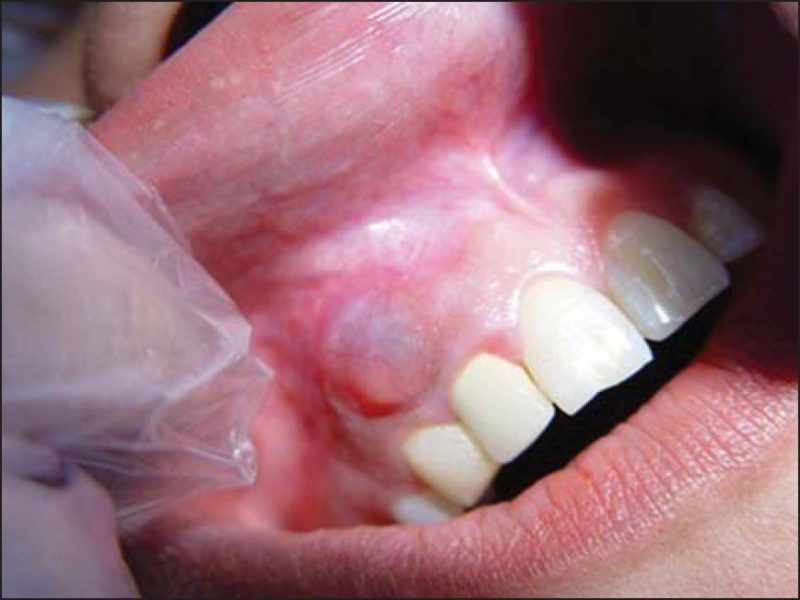 کیست دندان | کیست دندان چرا بوجود می آید و علائم و درمان آن چیست؟
