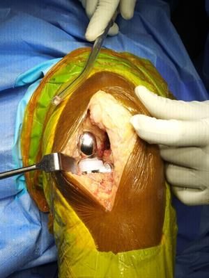 تعویض مفصل زانو یا آرتروپلاستی زانو؛ احیای زانو با عمل جراحی