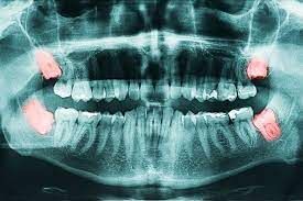 دندان عقل | دندان عقل و نکاتی درباره جراحی آن