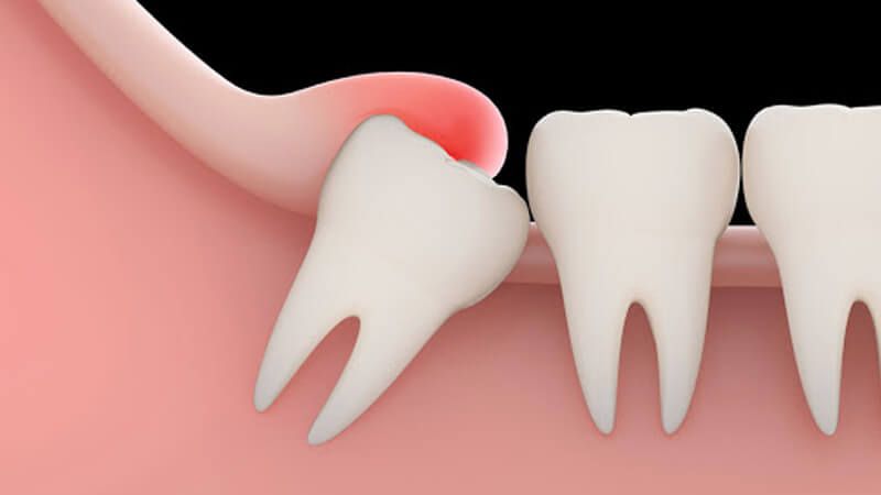 دندان عقل | دندان عقل و نکاتی درباره جراحی آن