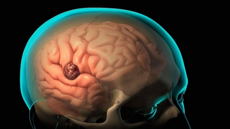 آبسه مغزی یا اپی دورال چیست؟ | آبسه مغزی چه علائم و عوارضی دارد؟