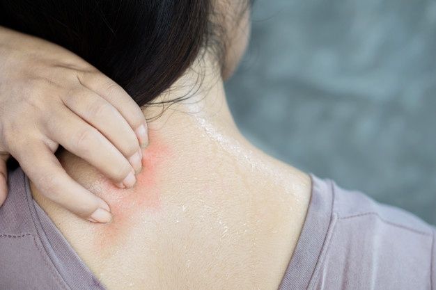 سندروم مورجلن | سندروم مورجلن؛ وقتی فکر می کنید حشره ای روی پوستتان است