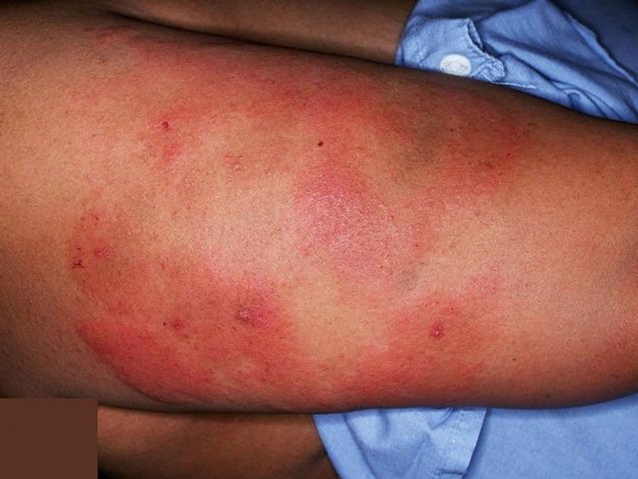 ترومبوسیتوپنی یا کاهش تعداد پلاکت ها اگر نادیده گرفته شود می تواند کشنده باشد