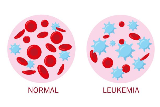سرطان خون یا لوسمی یا لوکمیا | تمام اطلاعات درباره علایم، علل و درمان سرطان خون