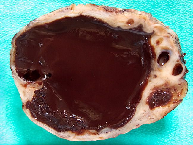 کیست شکلاتی یا آندومتریوم یکی از انواع کیست تخمدان