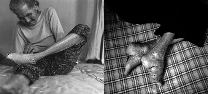 رسم بستن پاهای زنان در چین؛ جنون دردناک زیبایی برای مردان