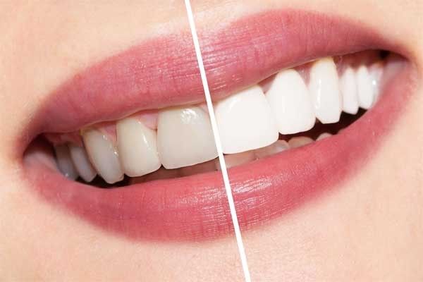 معایب و عوارض لمینت دندان که بسیار مهم است!