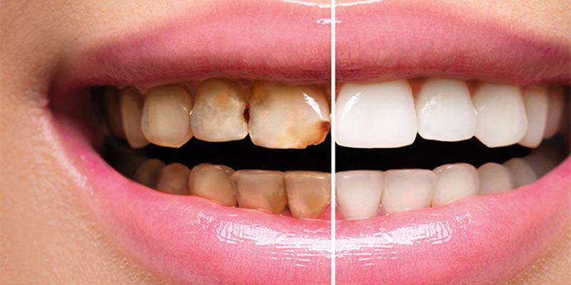 اطلاعاتی که درباره ترمیم دندان باید بدانید | اینلی و آنلی چیست؟