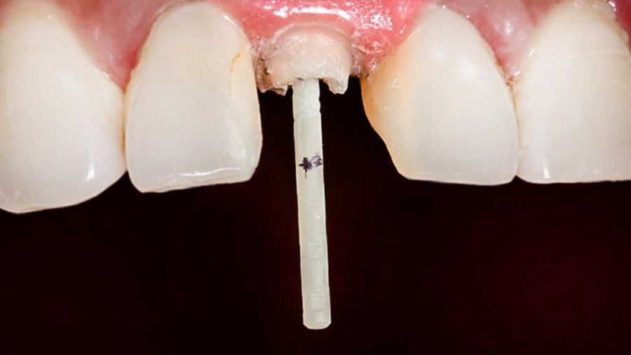 پست و کور دندان روشی برای احیای دندان است که باید بدانید