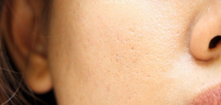 8 روش که به درمان منافذ باز پوست کمک خواهد کرد