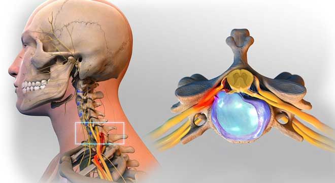 فتق یا بیرون زدگی دیسک گردن؛ انواع، علل و درمان های فتق دیسک گردن