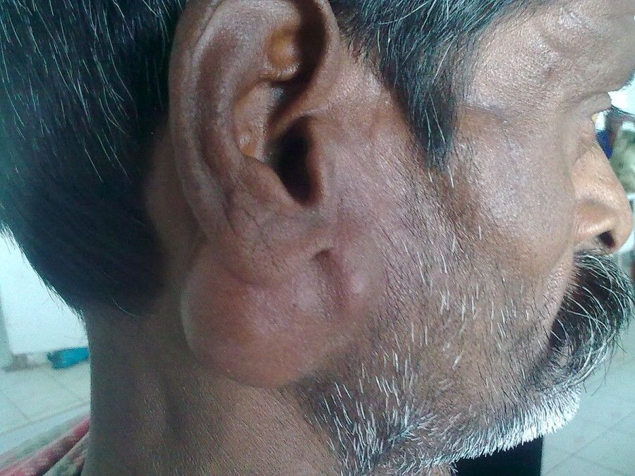 تومورهای پاروتید؛ نحوه تشخیص و درمان تومورهای پاروتید
