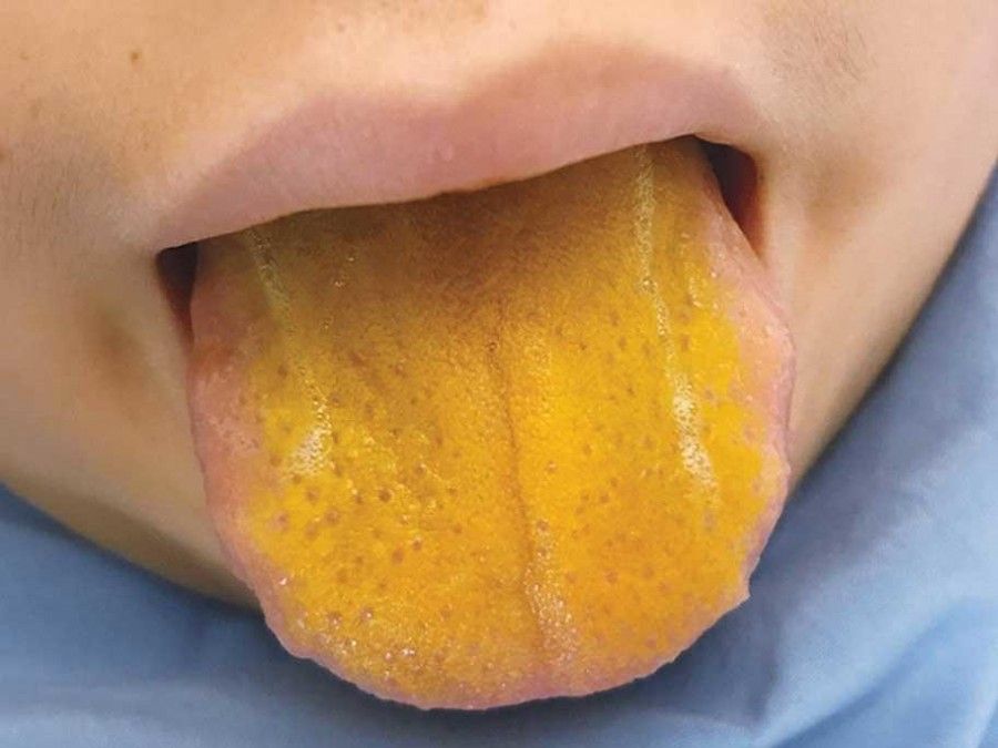 زردی زبان | چرا زبان زرد رنگ می شود؟
