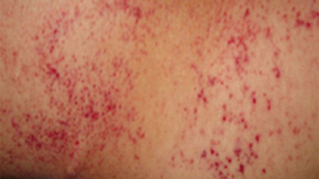 پتشی چیست و چرا ایجاد می شود؟