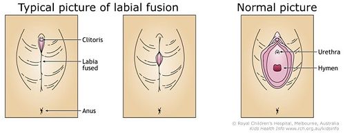 چسبندگی لبیال (Labial fusion) یا چسبندگی آلت تناسلی در دختران چیست؟
