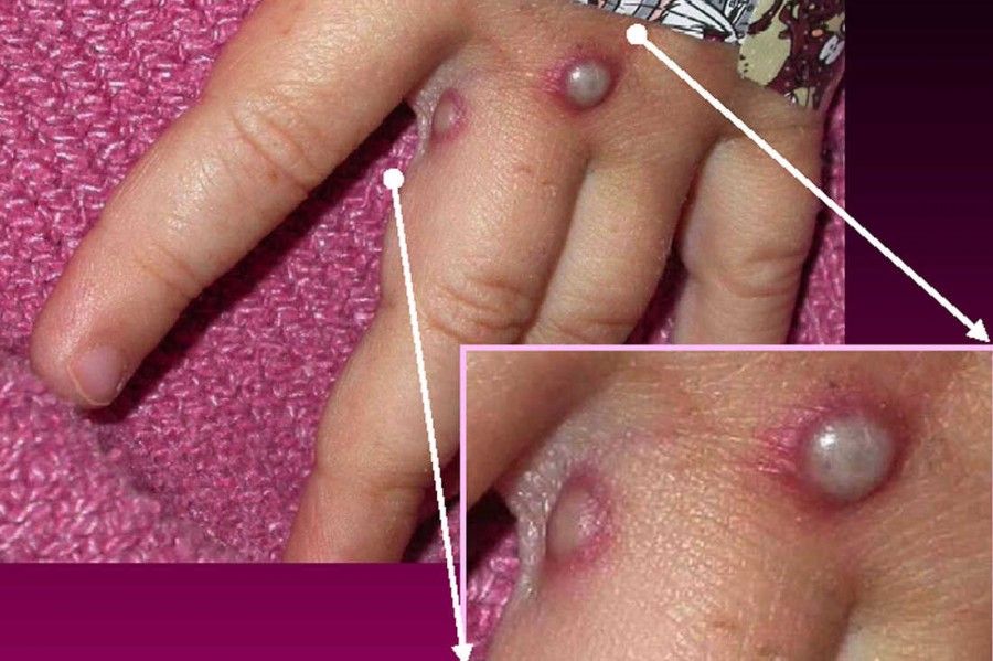 تمام آنچه درباره آبله میمون باید بدانید