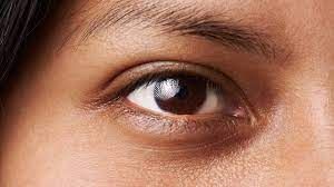 حلقه های سیاه زیر چشم و تمام اطلاعات درباره آن