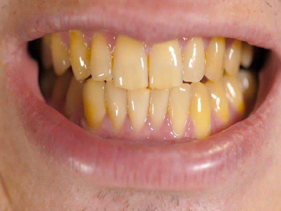 چرا دندان ها زرد می شوند؟ راه های پیشگیری و رفع زردی دندان چیست؟