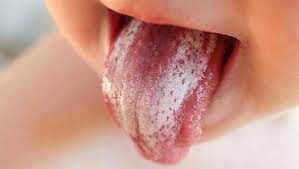 روش های خانگی درمان سوختگی زبان و دهان