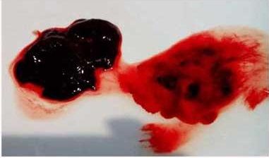 لخته خون گوشتی در پریودی: علل، علائم و راهکارهای مدیریت خونریزی