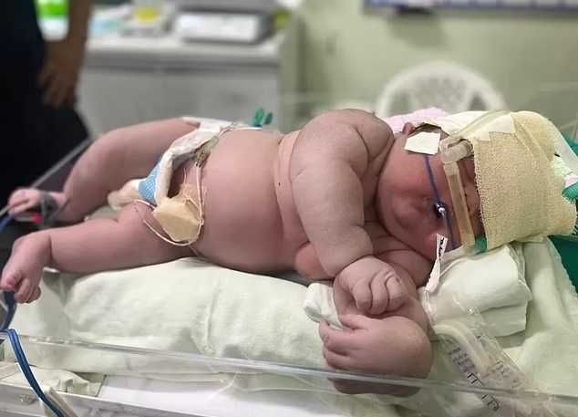 تولد نوزاد ۷ کیلوگرمی با ۶۰ سانتیمتر قد از طریق سزارین در برزیل