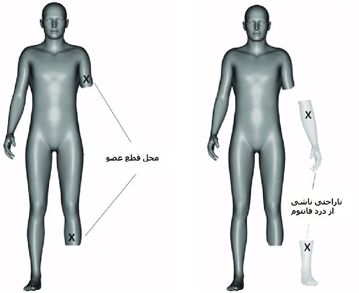 درد فانتوم یا درد خیالی چیست و چه علائم و راه های درمانی دارد؟