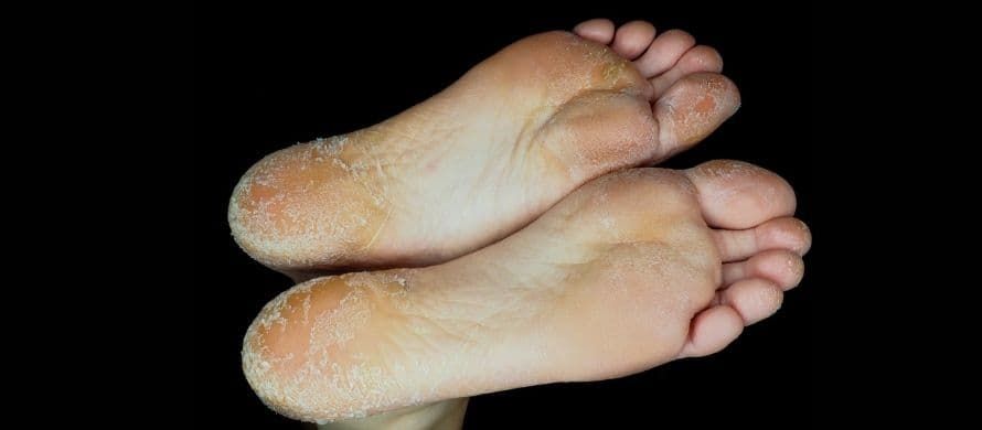 پوسته شدن کف پا چیست و چه دلایلی دارد؟