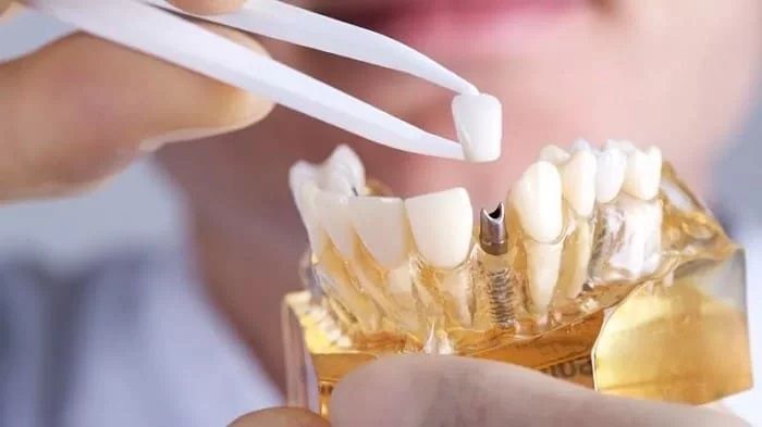 4 دلیل لق شدن دندان ایمپلنت شده