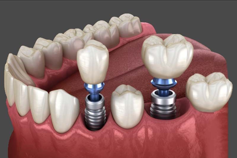 مهمترین علایم عفونت ایمپلنت دندان که باید آن ها را جدی گرفت