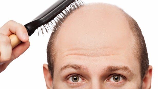 آیا ریزش مو می‌تواند نشانگر خطر بیماری‌های قلبی باشد؟ مطالعه‌ای چه می گویند؟