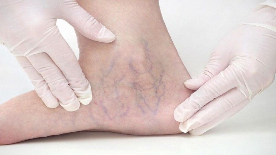 مبتلایان به واریس و تغذیه آنها