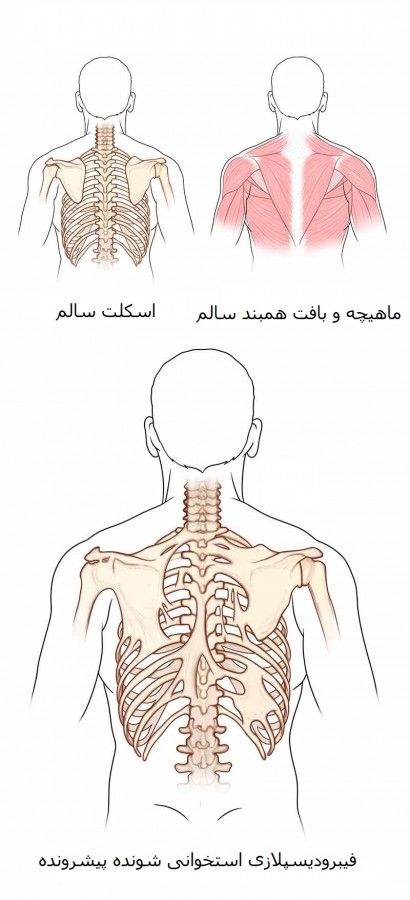 تمام اطلاعات درباره بیماری سندرم مرد سنگی