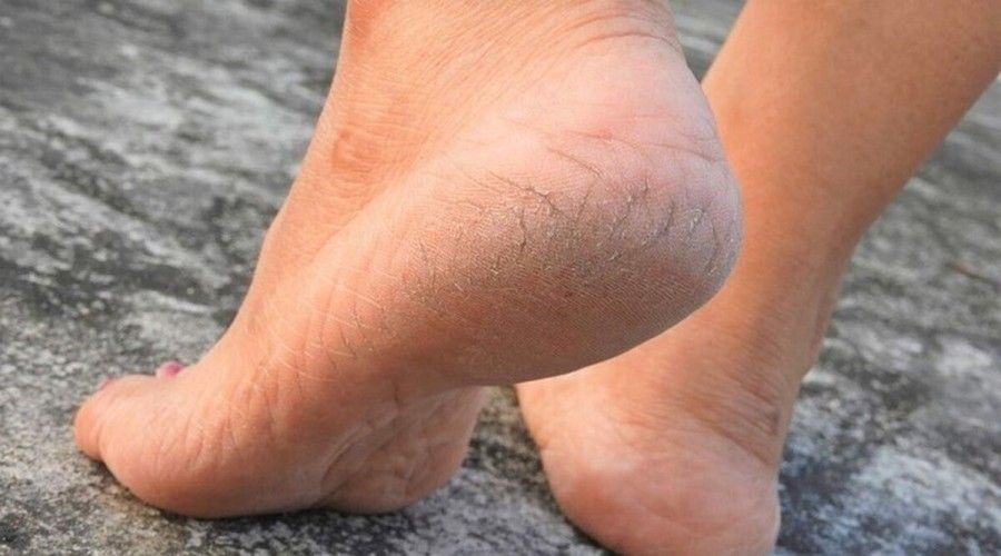 کمبود چه ویتامینی باعث ترک پاشنه پا می شود؟