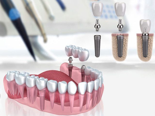 ایمپلنت دندان | انواع ایمپلنت دندان | خطرات و عوارض ایمپلنت دندان