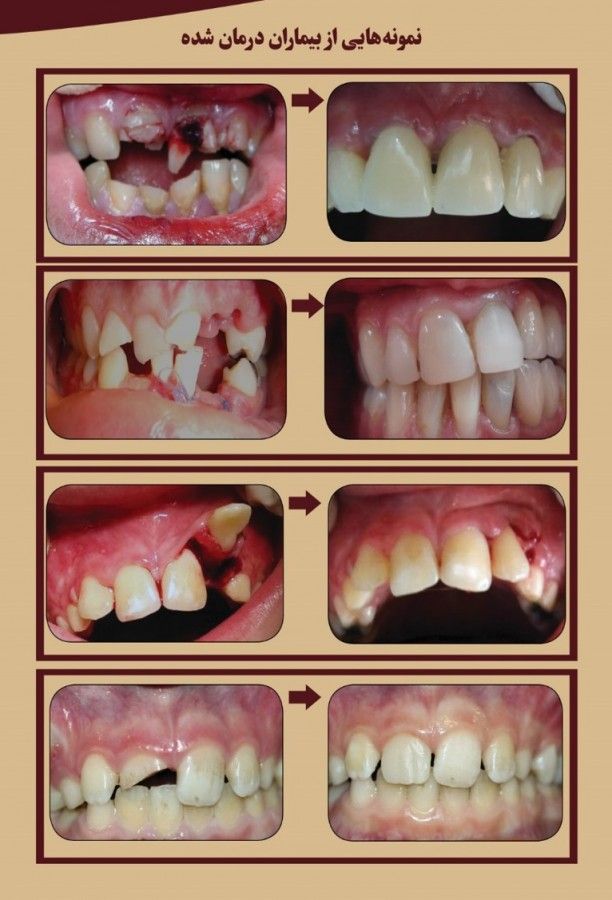 ترومای دندانی | انواع ترومای دندانی | مهمترین نکات هنگام ترومای دندانی