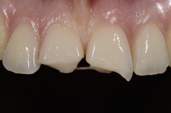 ترومای دندانی | انواع ترومای دندانی | مهمترین نکات هنگام ترومای دندانی