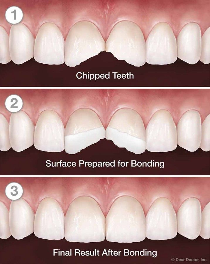 باندینگ دندان | موارد استفاده از باندینگ دندان | مزایای باندینگ دندان | طول عمر باندینگ دندان