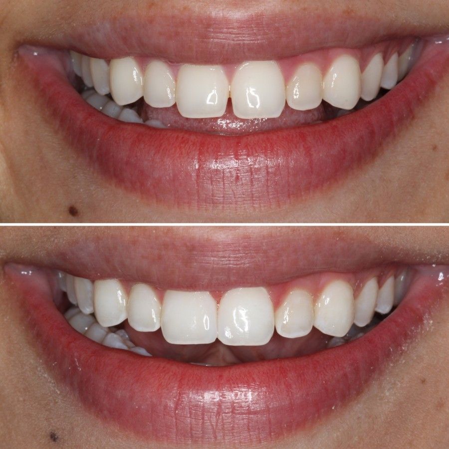 باندینگ دندان | موارد استفاده از باندینگ دندان | مزایای باندینگ دندان | طول عمر باندینگ دندان