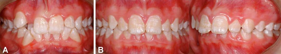 فلوئوروزیس دندانی | علل فلوئوروزیس دندانی | علائم فلوئوروزیس دندانی | درمان فلوئوروزیس دندانی