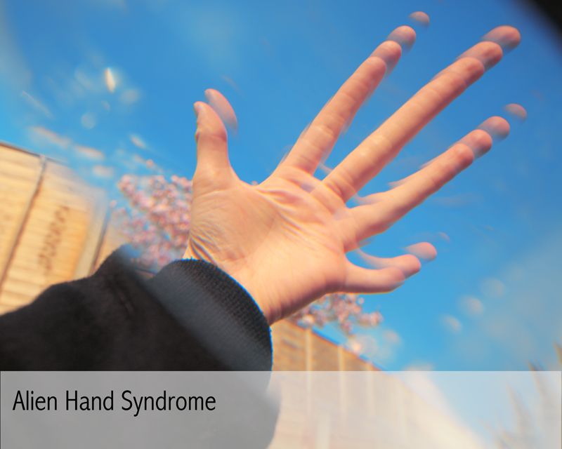 سندروم دست بیگانه | دلایل ایجاد دست بیگانه | علائم سندرم دست بیگانه | درمان سندرم دست بیگانه