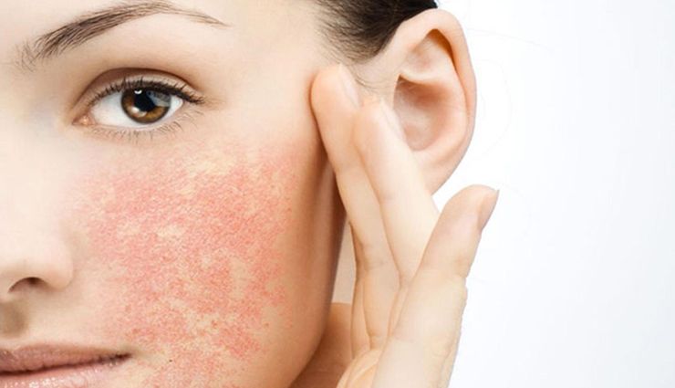 خشکی پوست چیست؟ | علائم و علل خشکی پوست | اشتباهات رایج در مراقبت از پوست خشک