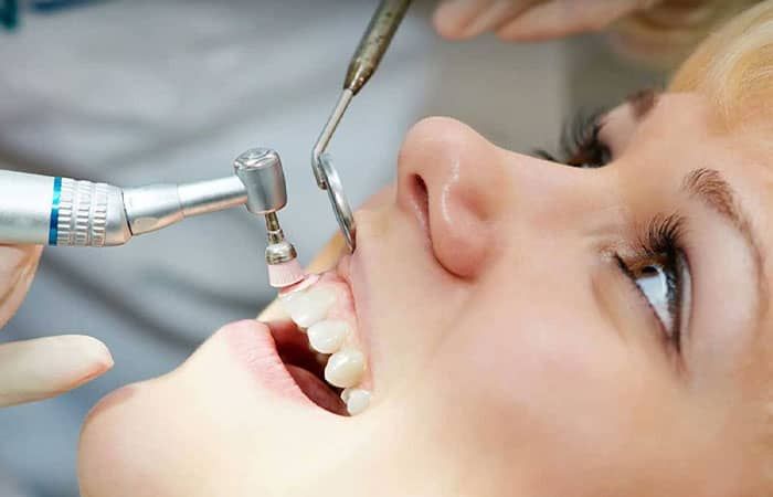 جرم گیری دندان یا بروساژ دندان 